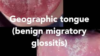 Geographic tongue Also called benign migratory glossitis [upl. by Greenleaf450]