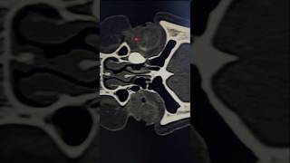 Dacryocystitis Due to Nasolacrimal Duct Blockage in EYECTDCG SCAN CTSCAN CTORBIT skullbase [upl. by Duyne681]