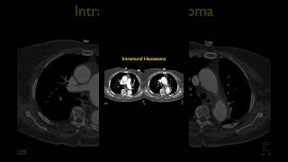 Intramural Hematoma [upl. by Emyaj]