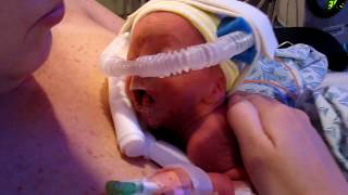 Dylans First Hug  Baby Born Premature at 29 Weeks 2009 [upl. by Grounds730]