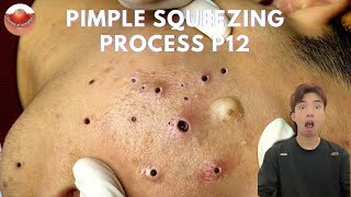 The MOST TERRIFYING Acne Squeezing Videos Youve Ever Seen 12 [upl. by Giordano125]