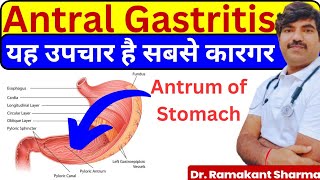 Antral Gastritis Causes Symptoms and Effective Treatments drramakantsharma7 [upl. by Padgett267]