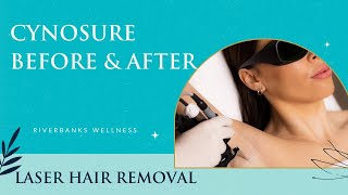 Cynosure Laser Hair Removal Before amp After  What You Need to Know [upl. by Julietta]