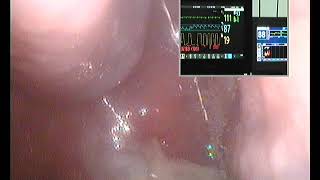 Drug Induced Sleep Endoscopy large adenoids and tonsils in 51 year old [upl. by Cutler395]