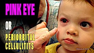 LIVE DIAGNOSIS Pink Eye or Periorbital Cellulitis  Dr Paul [upl. by Ihtac]