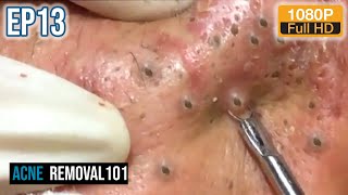 Cystic Acne Extraction 32mn  Blackheads Removal by ACNEREMOVAL101 [upl. by Anina]