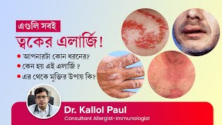 এলার্জি কত প্রকার এর থেকে মুক্তির উপায় কি  Types of allergy in skin amp How to cure allergy in skin [upl. by Alleuqram996]