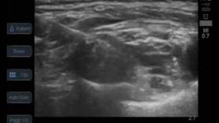 ultrasound guided supraclavicular brachial plexus block [upl. by Assiar]