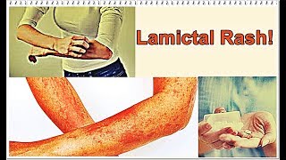 Lamictal Rash – Symptoms Treatment [upl. by Tratner]