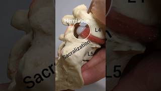 Disc Herniation Model with Lumbosacral Transitional Vertebrae [upl. by Cadmarr359]