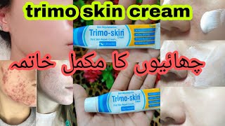 Trimo skin  trimo skin acne cream  trimo skin review  su beauty and remedies [upl. by Forcier]