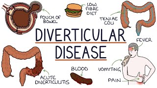 Understanding Diverticulosis and Diverticulitis [upl. by Yremogtnom702]