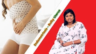 Endometriosis – Bulky Uterus  Ethnic Health Care  Dr BYoga Vidhya 2018 English [upl. by Onilecram809]