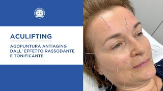 Trattamento Aculifting [upl. by Atilahs]