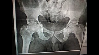 Acetabulum Percutaneous technique  Dr Ramprasad K MSORTHO AIIMS FAOA AUS A1 ORTHOCARE [upl. by Freeborn93]