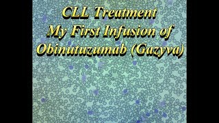 My First Obinutuzumab Gazyva Infusion [upl. by Kotta]