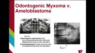 Odontogenic myxoma [upl. by Cash]