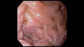 Duodenal ulcer [upl. by Palm]