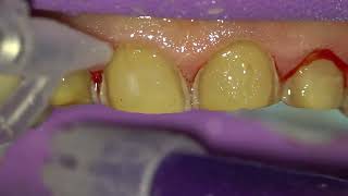 Testarea eficientei pastei de retractie Access Edge Hemostaza si retractie inainte de cimentare [upl. by Llaccm]