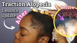 HOW I GREW MY EDGES IN 1 MONTH  Traction Alopecia [upl. by Aretta]