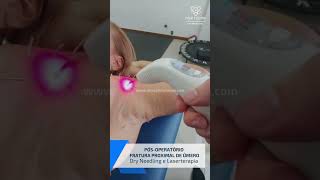 PO FRATURA proximal de úmero  Laserterapia e Dry Needling [upl. by Ecylahs]