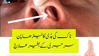 Deviated nasal septum treatment without surgery  DNS  Homeopathy [upl. by Annaiek]