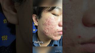 Severe acne before and after isotretinoin 1 year treatment acne isotretinoin jerawat acnescars [upl. by Litch]