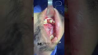 surgical extraction of vertically impacted lower premolar through lingual approach [upl. by Onailimixam]