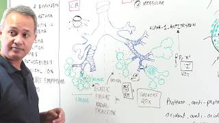 Emphysema  Clinical Presentation Diagnosis and Management [upl. by Babita257]