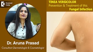 White Patches on Skin Is it TINEA VERSICOLOR  Is it Fungal  DrAruna Prasad  Doctors Circle [upl. by Marjy745]