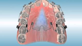 Nitanium® Palatal Expander²™ MultiPurpose Finishing Appliance [upl. by Kamillah522]