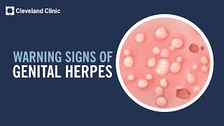 5 Warning Signs of Genital Herpes [upl. by Analla]