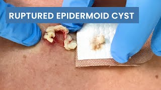 Removing a Ruptured Epidermoid Cyst  CONTOUR DERMATOLOGY [upl. by Chara484]