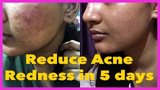 How to get Rid of Acne Redness Naturally at home  Somi Singh [upl. by Kemme]