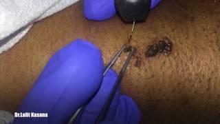 WART REMOVAL Magical Result by DR LALIT KASANA [upl. by Peltier306]