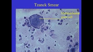 Tzanck smear Positive [upl. by Rotceh]