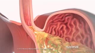 reflü ve tedavisi [upl. by Proud]