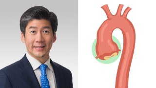 Surgeon QampA What Are Annual Growth Rates for Aortic Aneurysms [upl. by Necyrb]