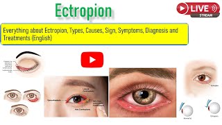 Everything about ectropion Types Sign Symptoms and Treatment option including surgury [upl. by Winnah]