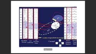 Ventricular tach localisation by ecg VTlocalisation ventriculartachycardia VPC [upl. by Ariak]