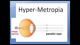 Ophthalmology 044 b HyperMetropia HyperOpia long sightedness Shot silk appearance pseudopapillitis [upl. by Liahcim469]