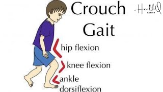 Exercises for crouched gait [upl. by Landau]