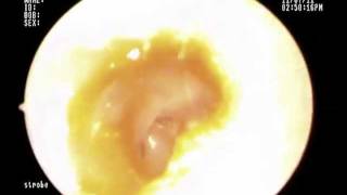 Total Ear Drum Perforation [upl. by Akenor]