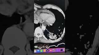 Pulmonary sequestration with small thoracic aorta branch [upl. by Sibel299]