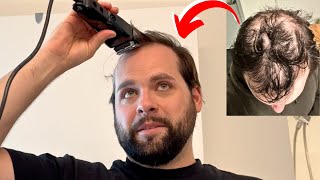 I Tried EVERYTHING For BALDING  Head Shave TRANSFORMATION [upl. by Ribal]