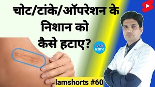 चोटटांकेऑपरेशन के निशान को कैसे हटाए Shorts lamshorts [upl. by Wrdna]