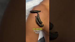 Leech Therapy for Shoulder Pain [upl. by Nahej212]