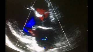 Ecocardiograma Complicaciones del Infarto al miocardio [upl. by Swarts193]