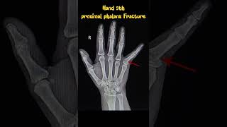 Hand fracture xray fracture radiology orthopedics xrays [upl. by Bollinger186]