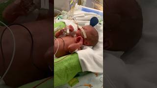 Miracle baby survives at 27 weeks shorts [upl. by Johns545]